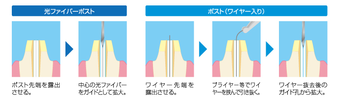 再根管治療が容易