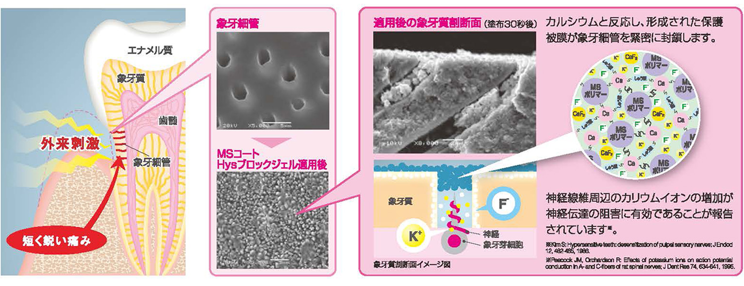 高い知覚過敏抑制効果