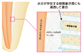 歯質界面から重合開始