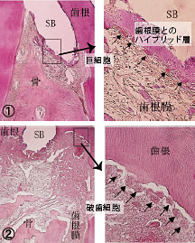 髄床底穿孔部を封鎖し4週後