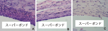 スーパーボンド硬化時の血液浸潤と炎症