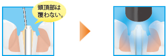 ポストレジン築盛の際のポイント 頭頂部は覆わない