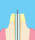 ポスト(ワイヤー入り) ワイヤー先端(4~5mm)を露出させる