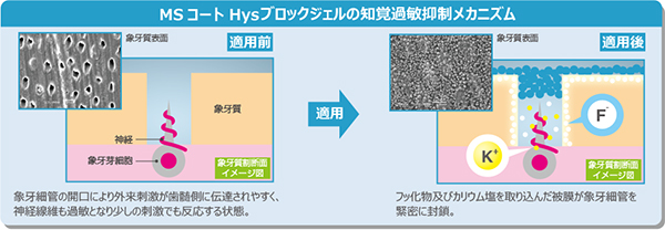 ＭＳコート Ｈｙｓブロックジェルの知覚過敏抑制メカニズム