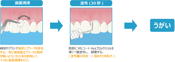 ＭＳコート Ｈｙｓブロックジェル 操作ステップ