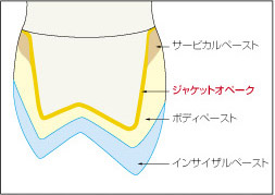 支台歯が天然歯、レジン