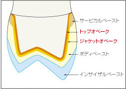 支台歯が変色歯、メタル